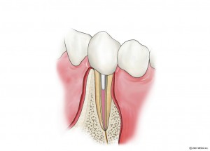 感染根管治療6　被せ物の装着